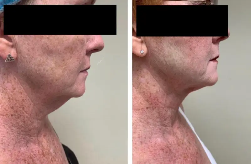 j plasma before and after
